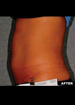 After Image: Liposonix® Patient 3 - other