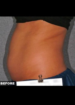 Before Image: Liposonix® Patient 3 - other