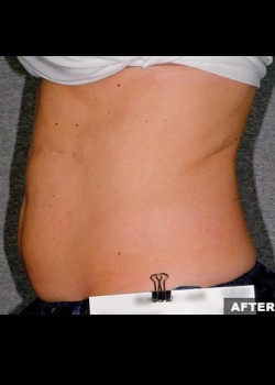 After Image: Liposonix® Patient 4 - other