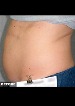 Before Image: Liposonix® Patient 4 - other
