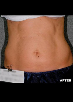 After Image: Liposonix® Patient 5 - front