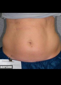 Before Image: Liposonix® Patient 5 - front