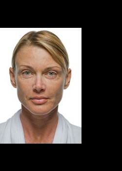 After Image: Radiesse® Patient 1 - front