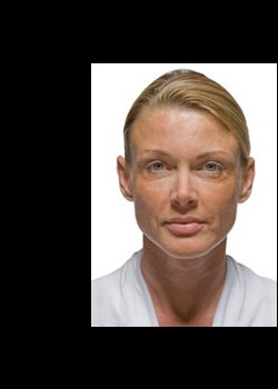 Before Image: Radiesse® Patient 1 - front