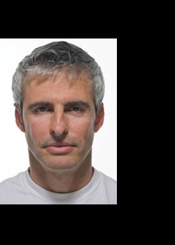 After Image: Radiesse® Patient 2 - front