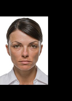 After Image: Radiesse® Patient 3 - front