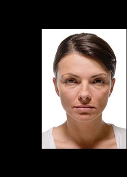 Before Image: Radiesse® Patient 3 - front