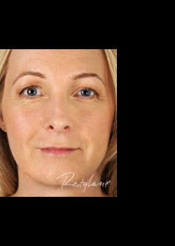 After Image: Restylane® Patient 1 - front