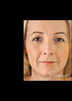 Before Image: Restylane® Patient 1 - front