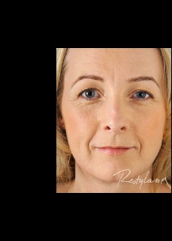 Restylane® Patient 1