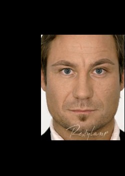 Before Image: Restylane® Patient 2 - front