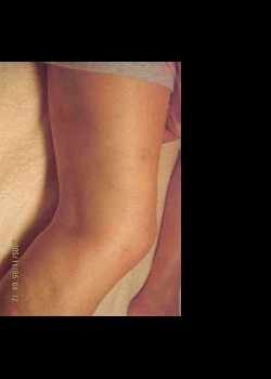After Image: Veins – Vascular Patient 1 - other