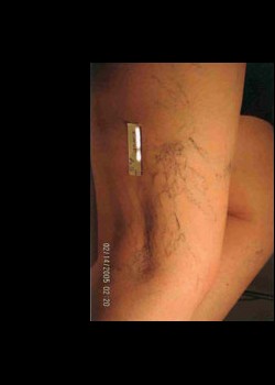 Before Image: Veins – Vascular Patient 1 - other