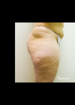 Before Image: VelaShape™ Patient 1 - other