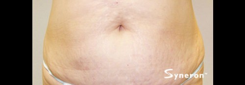 After Image: VelaShape™ Patient 3 - front