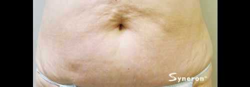 Before Image: VelaShape™ Patient 3 - front