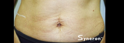 After Image: VelaShape™ Patient 4 - front