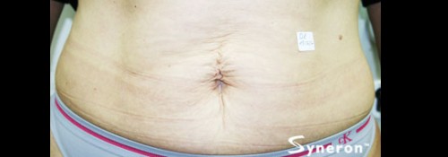 Before Image: VelaShape™ Patient 4 - front