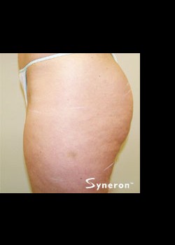After Image: VelaShape™ Patient 5 - other