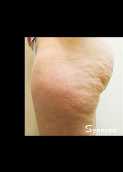 Before Image: VelaShape™ Patient 5 - other