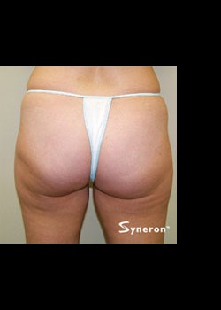 After Image: VelaShape™ Patient 6 - back