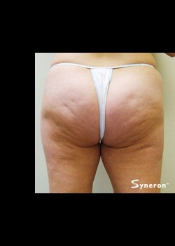 Before Image: VelaShape™ Patient 6 - back
