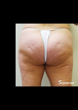 VelaShape™ Patient 6