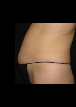 VelaShape™ Patient 7