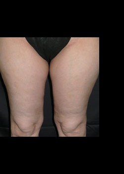 After Image: VelaShape™ Patient 8 - front