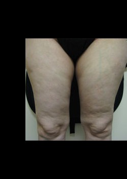 Before Image: VelaShape™ Patient 8 - front