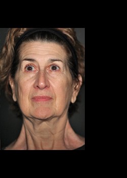 After Image: Pellevé® Patient 1 - front