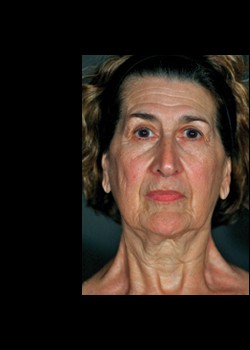 Before Image: Pellevé® Patient 1 - front