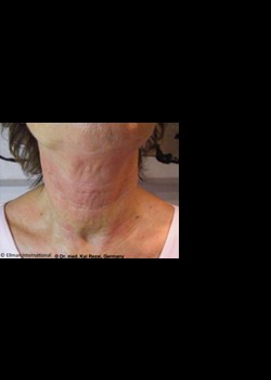 After Image: Pellevé® Patient 2 - front