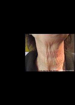 Before Image: Pellevé® Patient 2 - front