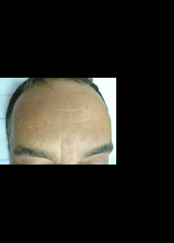 After Image: Pellevé® Patient 3 - front