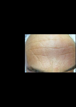 Before Image: Pellevé® Patient 3 - front