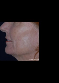 After Image: Pellevé® Patient 4 - front