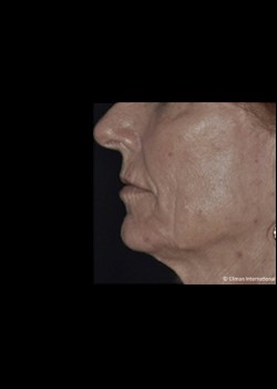 Before Image: Pellevé® Patient 4 - front