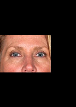 After Image: Pellevé® Patient 5 - front