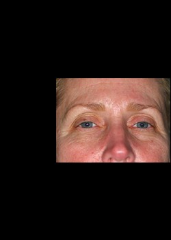 Before Image: Pellevé® Patient 5 - front