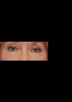 After Image: Pellevé® Patient 6 - front