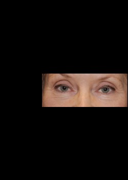 Before Image: Pellevé® Patient 6 - front