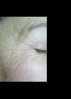 After Image: Pellevé® Patient 8 - other