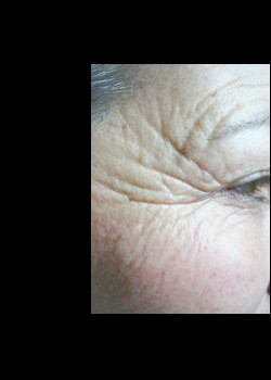 Before Image: Pellevé® Patient 8 - other