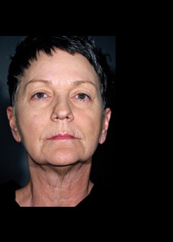 After Image: Pellevé® Patient 9 - front