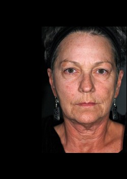 Before Image: Pellevé® Patient 9 - front