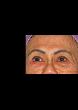 Before Image: Pellevé® Patient 11 - front