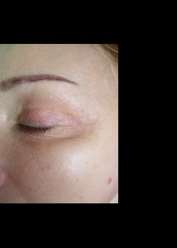 After Image: Pellevé® Patient 12 - other
