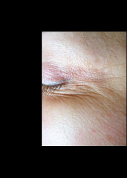 Before Image: Pellevé® Patient 12 - other