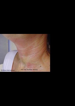 After Image: Pellevé® Patient 13 - other